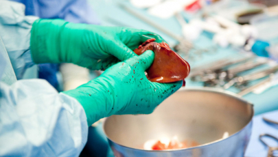 Teilentnahme einer Spender-Leber für eine Transplantation.