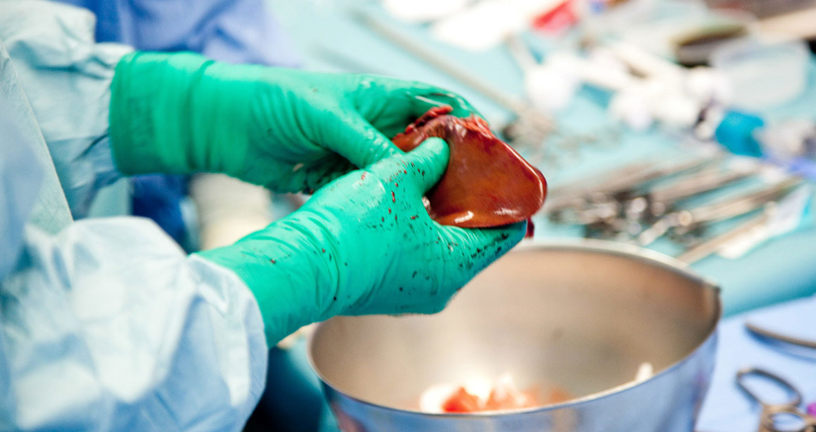 Teilentnahme einer Spender-Leber für eine Transplantation. Teilentnahme einer Spender-Leber für eine Transplantation.